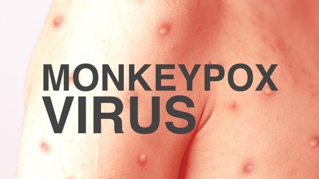 Monkeypox, Global Emergency, India Monkeypox case, India, Monkeypox virus, delhi, મંકીપોક્સ, ભારતમાં મંકીપોક્સ, 